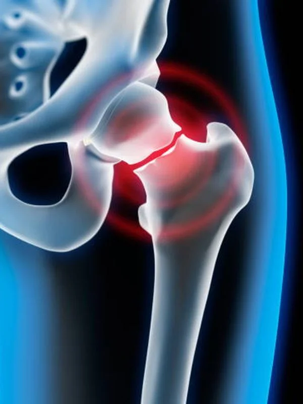 Rehabilitación después de fracturas